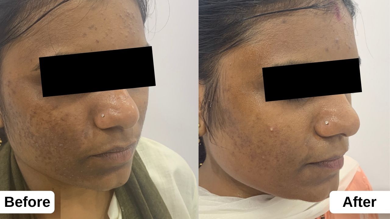 Solution for Acne Treatment & Cost Derma Space